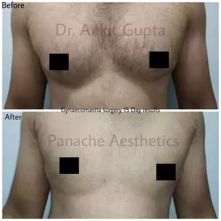 Gynecomastia (man boobs) surgery before and after — Dr. Ankit Gupta, Delhi